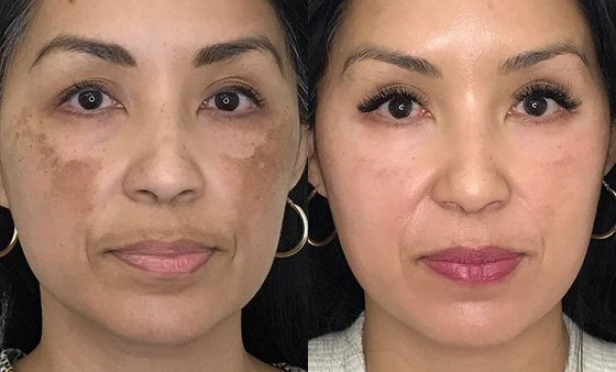 Age-Spots-Removal- before after picture