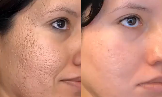 Laser-Skin-Resurfacing-before after picture