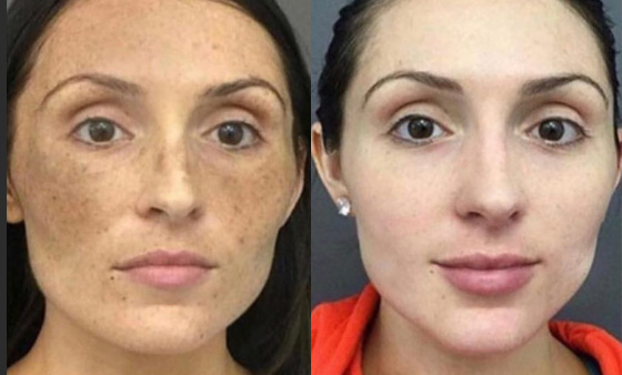Melasma-Treatment before after picture