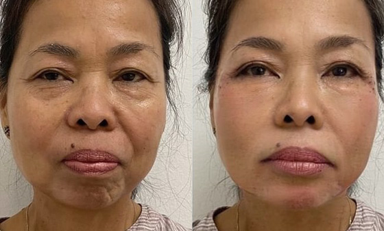 Non Surgical Skin Tightening before after picture