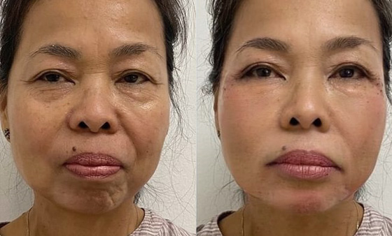 SKIN TIGHTENING BEFORE & AFTER PHOTOS