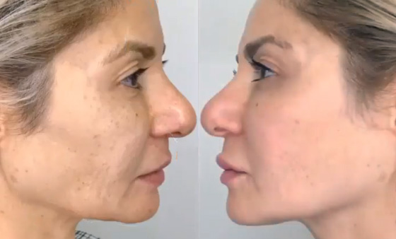 Non-Surgical-Wrinkle-Removal-before after picture