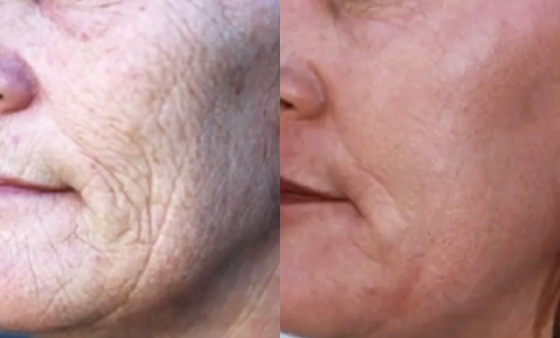 Non-Surgical-Wrinkle-Removal-before after picture