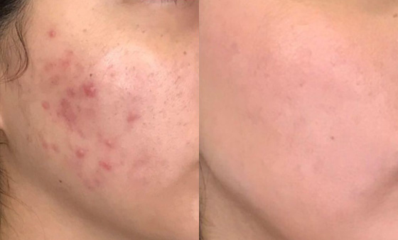 Rosacea-Treatment-before after picture