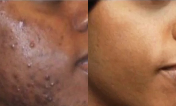 Rosacea-Treatment-before after picture