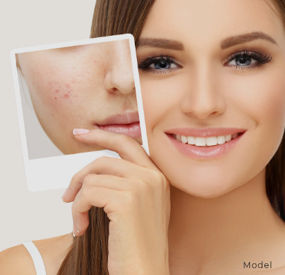 Acne-Scar-removal-Banner