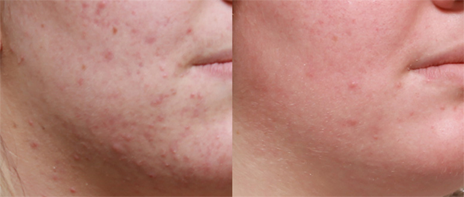 acne-before-after-image