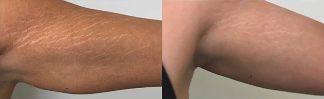 Non-Surgical-Arm-Lift-before after picture
