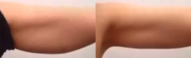 Non-Surgical-Arm-Lift-before after picture