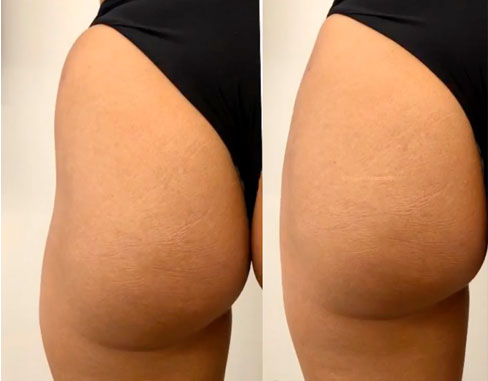 Non-Surgical-Butt-Liftbefore-after-image