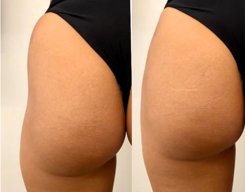 Non-Surgical Butt Lift by Simon Ourian