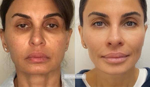 Non-Surgical-Facelift-before after image