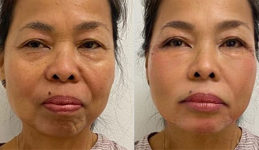 Non-Surgical-Facelift-Non-Surgical-Facelift-before after image