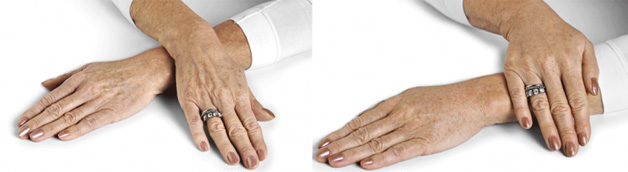 Non-Surgical-Hand-Rejuvenation- before after image