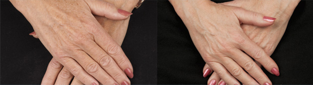 Non-Surgical-Hand-Rejuvenation- before after image