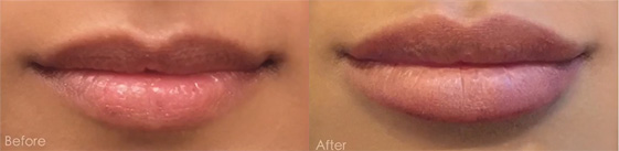 Non-Surgical-Lip-Augmentation before after image