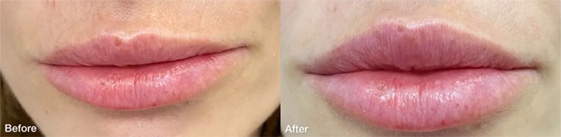 Non-Surgical-Lip-Augmentation before after image