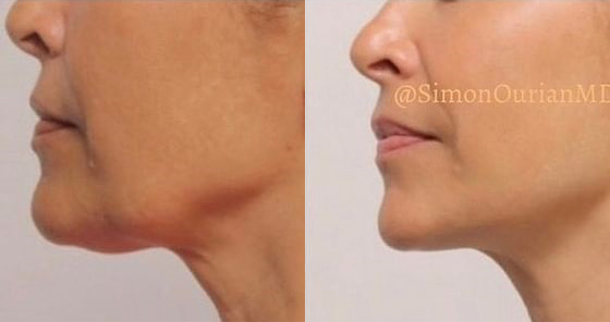 Non-Surgical-Neck-Lift-before after picture
