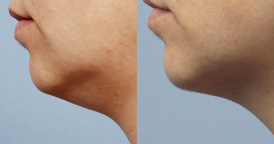 Non-Surgical-Neck-Lift-before after picture