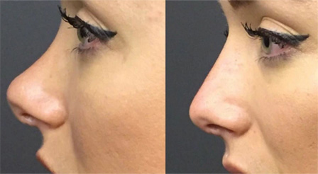 Non-Surgical-Nose-Job-before after image