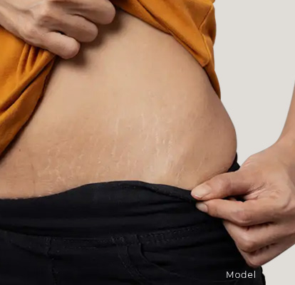 Stretch-Mark-Removal-Banner