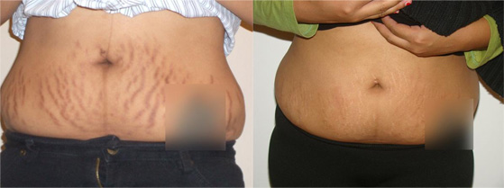 Stretch-Mark-Removal-before after image