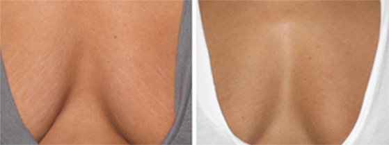 Stretch-Mark-Removal-before after image