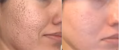 acne-before-after-image