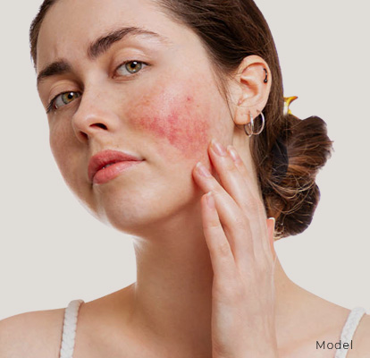 rosacea-treatment-Banner