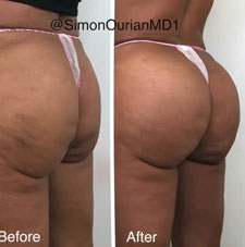 Brazilian Butt Lift image15