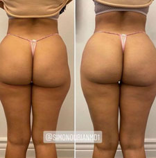 Brazilian Butt Lift image7