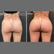 Brazilian Butt Lift image9