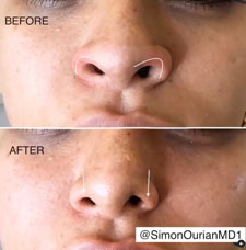 Non Surgical Nose Job image1