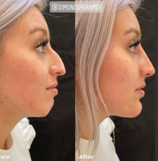 Non Surgical Nose Job image10