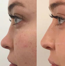 Non Surgical Nose Job image14