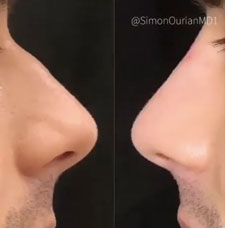 Non Surgical Nose Job image17