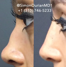 Non Surgical Nose Job image21