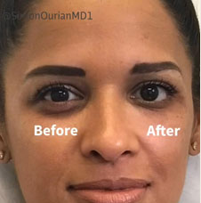 Non surgical dark circle removal image10