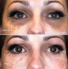 Non surgical dark circle removal image16