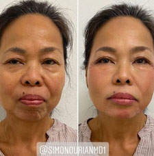 Non surgical facelift image1