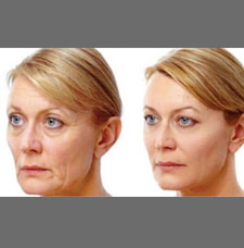 Non surgical facelift image10
