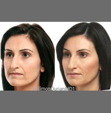 Non surgical facelift image11