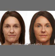 Non surgical facelift image12
