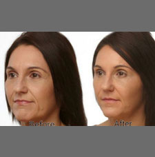 Non surgical facelift image13