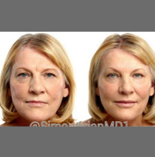 Non surgical facelift image14