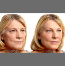 Non surgical facelift image15