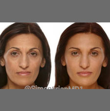 Non surgical facelift image16