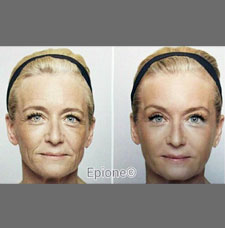 Non surgical facelift image17