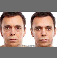 Non surgical facelift image18