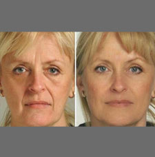 Non surgical facelift image19